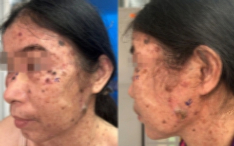 Ca bệnh hiếm gặp: Loạn sản thượng bì dạng hạt cơm tiến triển thành đa ung thư da