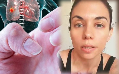Người phụ nữ 35 tuổi mất 2 năm mới biết mình bị ung thư phổi vì các triệu chứng bị nhầm lẫn là do căng thẳng
