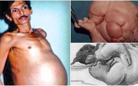 Người đàn ông mang trong mình "thai chết lưu" suốt 36 năm, bào thai nặng 4kg, có cả tóc và tay chân