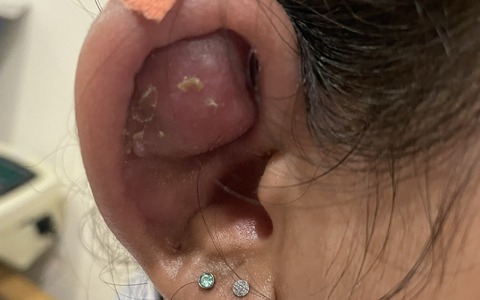 Thiếu nữ tai biến thành "Trư Bát Giới" sau làm đẹp