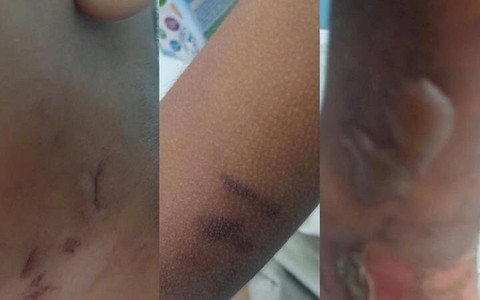 TP.HCM: Điều tra vụ bé 6 tuổi nghi bị bạo hành, bỏng cấp độ 2
