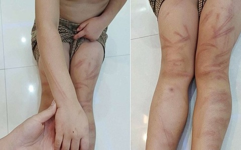 Tình hình sức khỏe mới nhất của 6 trẻ mầm non bị đánh bầm tím ở Nghệ An