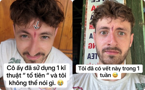 Khách Tây bất ngờ bị "phong ấn" trên trán vì trót than đau đầu khi tới Việt Nam