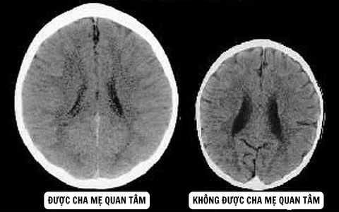 Bức ảnh não bộ của 2 em bé tiết lộ bí mật gây sốc về tình yêu thương của cha mẹ