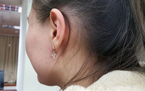 Phát hiện cổ bị bẩn nhưng không thể rửa sạch, bé gái 15 tuổi bàng hoàng khi bác sĩ nói "đây là một căn bệnh"