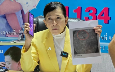 Đau bụng không rõ nguyên nhân nên đi khám, người phụ nữ phát hiện sai sót của y tá từ gần 20 năm trước