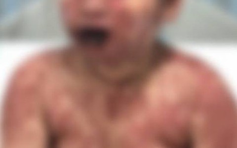 Chỉ nghĩ mình bệnh thông thường, nhiều người tự mua thuốc uống suýt mất mạng vì hội chứng này!