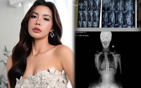 Minh Tú tiết lộ chưa có em bé vì đang mắc 1 bệnh liên quan đến cột sống, gây thoái hóa và mất xương, liệu có nguy hiểm?