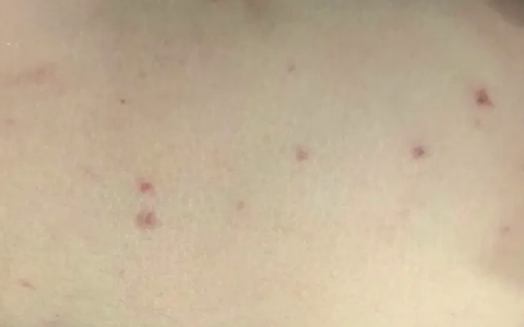 Trẻ mắc não mô cầu nặng do chưa tiêm vaccine phòng bệnh