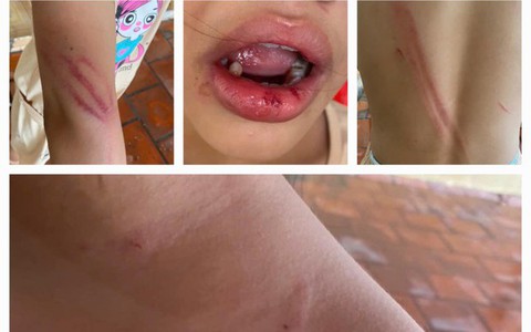 Bé gái 10 tuổi bị cha dượng đánh đập, người dân bức xúc báo công an