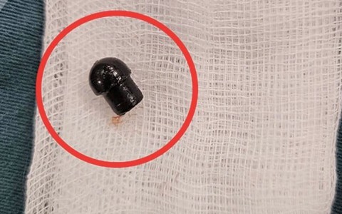Bé 7 tuổi tử vong do nuốt đầu nắp bút