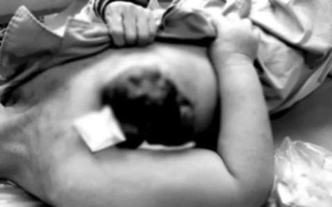 Đắp thuốc nam điều trị ung thư vú, người bệnh bị vỡ, loét hoại tử vú