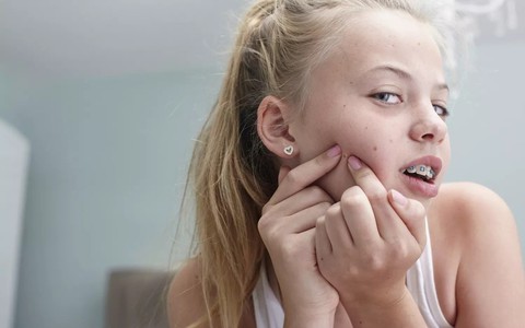 Nguyên tắc trị mụn dành cho thiếu niên