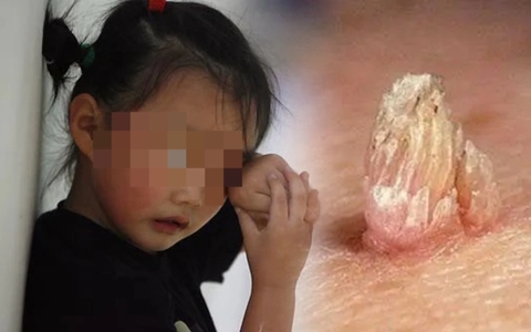 Con gái 4 tuổi mắc "bệnh người lớn" vì dùng chung 1 thứ với mẹ, nhiều gia đình có con nhỏ cũng đang mắc phải