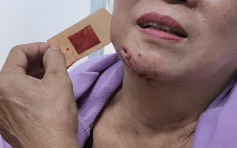 TP HCM phát văn bản khẩn phòng, chống bệnh dại