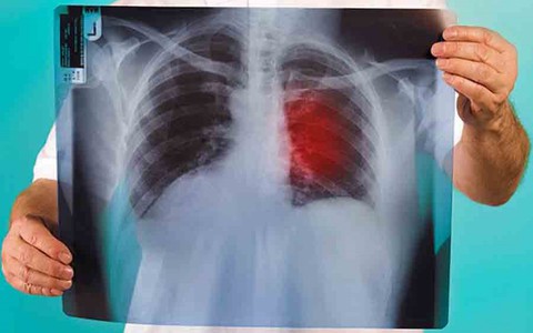 Anh: Phát triển vaccine đầu tiên trên thế giới ngừa ung thư phổi