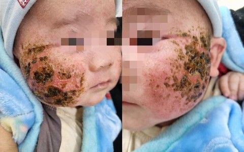Người nhà tự đắp lá cây chữa viêm da, bé 4 tháng tuổi bị loét má nặng