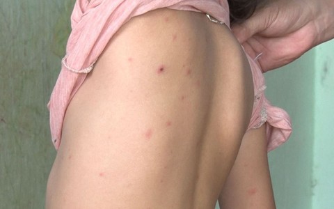 Đắk Lắk ghi nhận thêm 1 ổ dịch thủy đậu tại trường học