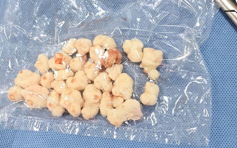 Lấy ra hàng chục “viên sỏi” trong khớp gối của cụ bà 71 tuổi