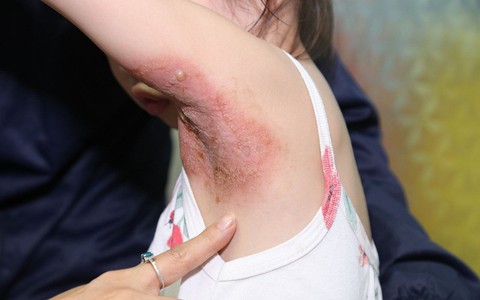 Phòng bệnh chốc lở ở trẻ em trong mùa nắng nóng