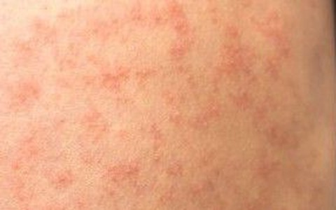 TP. Hồ Chí Minh ghi nhận 2 trường hợp mắc bệnh sởi trên trẻ chưa được tiêm vaccine