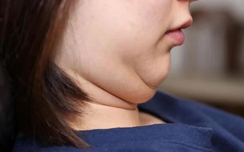 5 mẹo đơn giản giúp bạn giảm mỡ mặt mà không cần động dao kéo