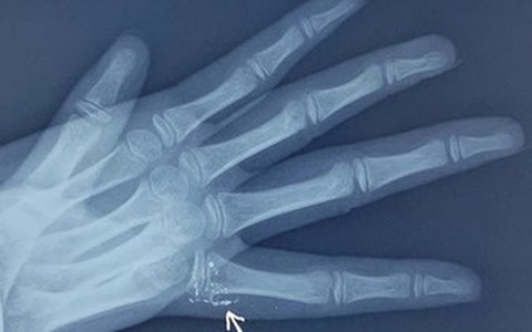 Nhiễm độc thủy ngân sẽ hại thận, phổi, não và hệ thần kinh