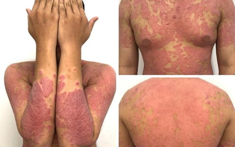 Căn bệnh khiến chàng trai da đỏ, sần sùi như khúc gỗ