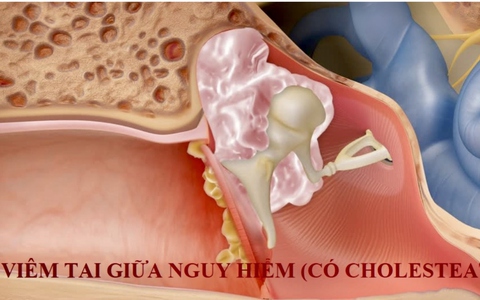Bác sĩ khuyến cáo phát hiện sớm các biến chứng cực kỳ nguy hiểm từ bệnh lý viêm tai giữa
