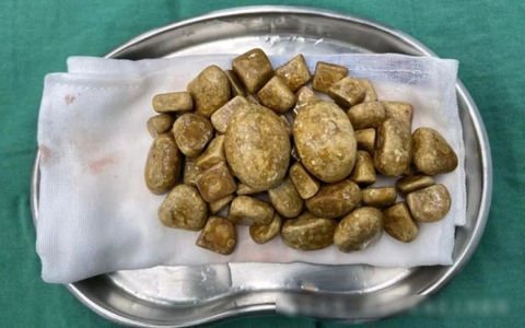 Lấy ra hơn 3kg sỏi từ bàng quang người đàn ông, nguyên nhân từ 'cái lười' tưởng vô hại của nhiều người