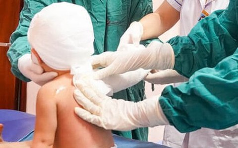 Bé ngã vào bát canh nóng, bôi mỡ trăn khiến bỏng càng nặng: Bác sĩ cảnh báo