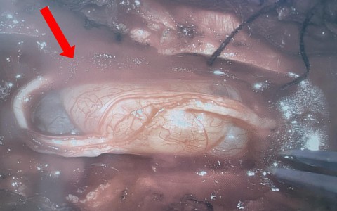 U tuỷ sống khiến cô gái 26 tuổi mất cảm giác hai chân