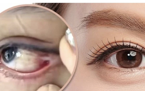 Đi cắt mí, cô gái bị khâu nhãn cầu với khóe mắt, muốn nhìn phải quay đầu