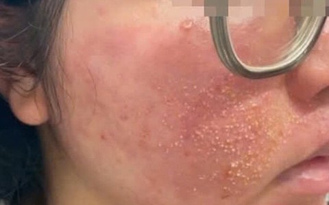 'Nát mặt' vì mua mỹ phẩm trị mụn theo quảng cáo trên mạng