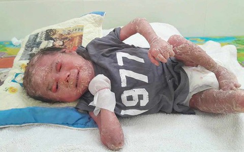 Bé trai 2 tuổi không có tinh hoàn, toàn thân nứt nẻ vì căn bệnh quái ác khiến ai nhìn cũng xót xa