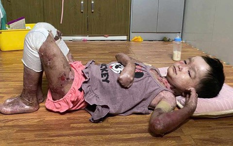 Bé gái 8 tuổi toàn thân lở loét, tứa máu vì căn bệnh quái ác