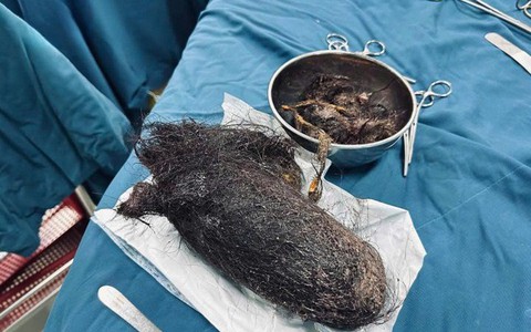 Bé gái 12 tuổi 'ăn' gần 1kg tóc, lấp kín hết dạ dày
