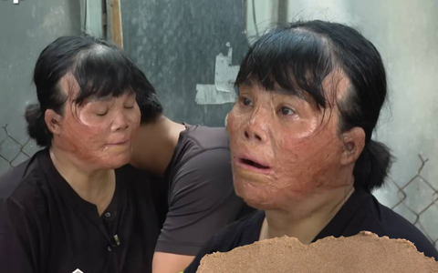 Người phụ nữ Đồng Tháp bỏng 78%, gương mặt biến dạng vì cứu một bé trai khỏi đám cháy, suốt 18 năm vẫn nuôi như con ruột