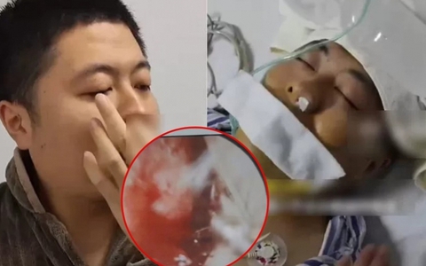 Người đàn ông vỡ động mạch, nhập viện cấp cứu vì thói quen nhiều người mắc phải