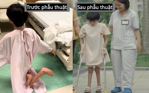 Sau 12 năm di chuyển bằng đầu gối, bé gái lần đầu được đi bằng chính đôi chân của mình