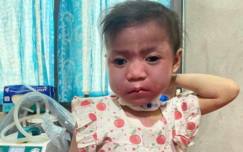 Mẹ mong níu giữ chút ánh sáng cho con gái 4 tuổi chưa biết nói, chưa biết đi, toàn thân đỏ thẫm vì bệnh quái ác