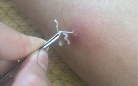 Bệnh do giun rồng tái xuất ở Việt Nam: ‘Sát thủ thầm lặng’ trở lại sau 20 năm