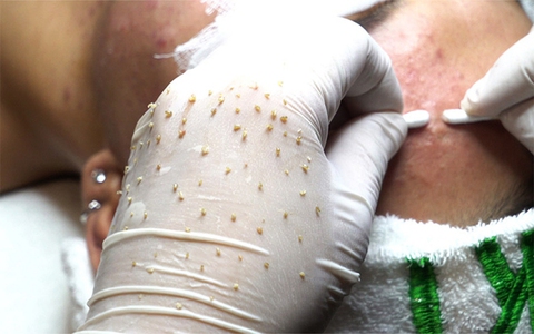 Chuyên gia lý giải vì sao những clip nặn mụn đáng sợ thu hút hàng triệu view