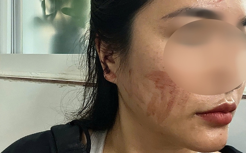 Kết quả giám định vụ cô gái cầu cứu sau khi bị bạn cùng phòng trọ hành hung rách tai vì lấy nhầm nồi nấu ăn