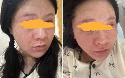 Mẹ bầu sinh con bất ngờ gặp “tai nạn đỏ mặt”: Dùng sức sai cách khiến toàn bộ khuôn mặt sưng đỏ và vỡ mạch máu
