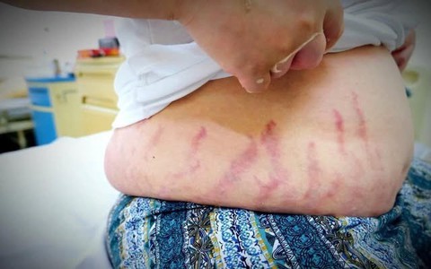 "Con tôi chỉ bị viêm mũi dị ứng thôi mà...": Người mẹ khóc nấc vì không ngờ thói quen xịt mũi lại khiến con bị suy tuyến thượng thận