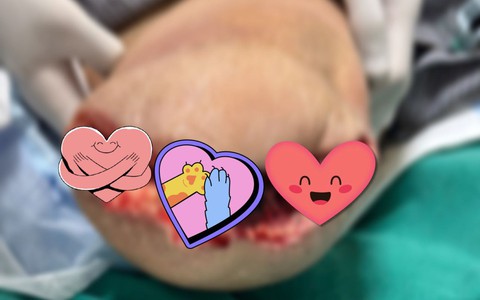 Giành giật sự sống từng giờ cho bệnh nhân ban đầu chỉ bị vết bỏng nhỏ ở chân: Ai mắc bệnh này hãy chăm sóc bàn chân thật cẩn thận!