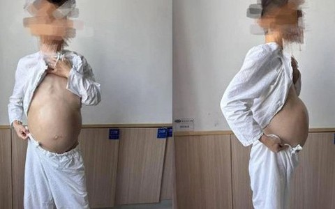 Người đàn ông 40 tuổi bụng to như mang bầu, khi phẫu thuật bác sĩ phát hiện điều đáng sợ