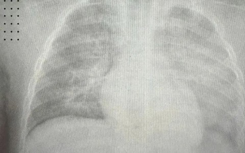 Bé 8 tháng tuổi phổi trắng xóa do biến chứng sởi