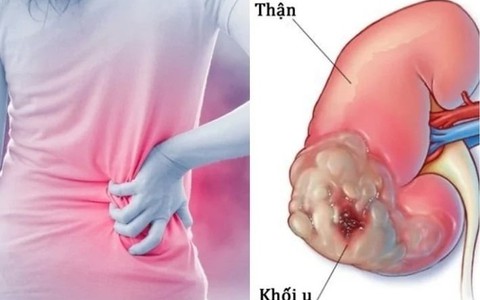 Dấu hiệu thầm lặng cảnh báo ung thư thận